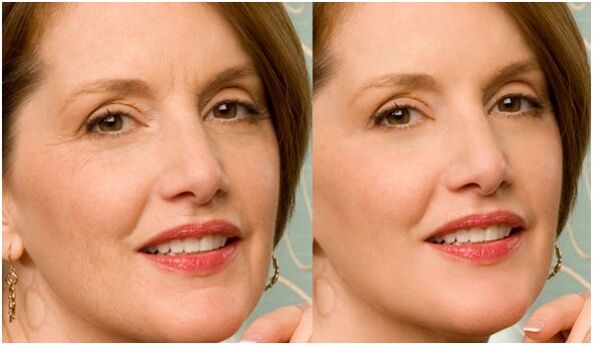 voor en na plasma gezichtshuidverjonging