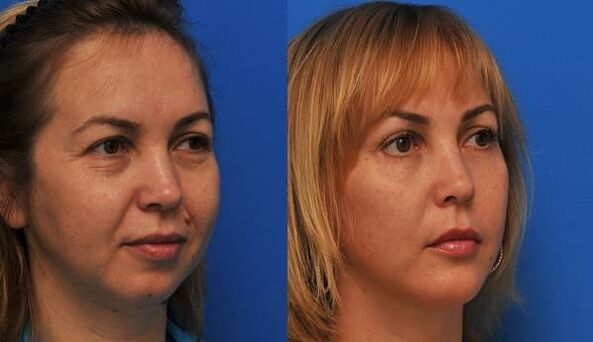 voor en na huidverjonging met aanscherping foto 1
