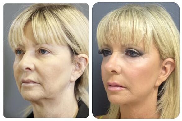 voor en na huidverjonging met aanscherping foto 2