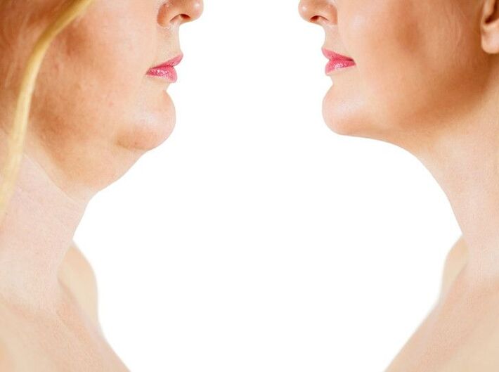 oorzaken van huidveroudering in de nek