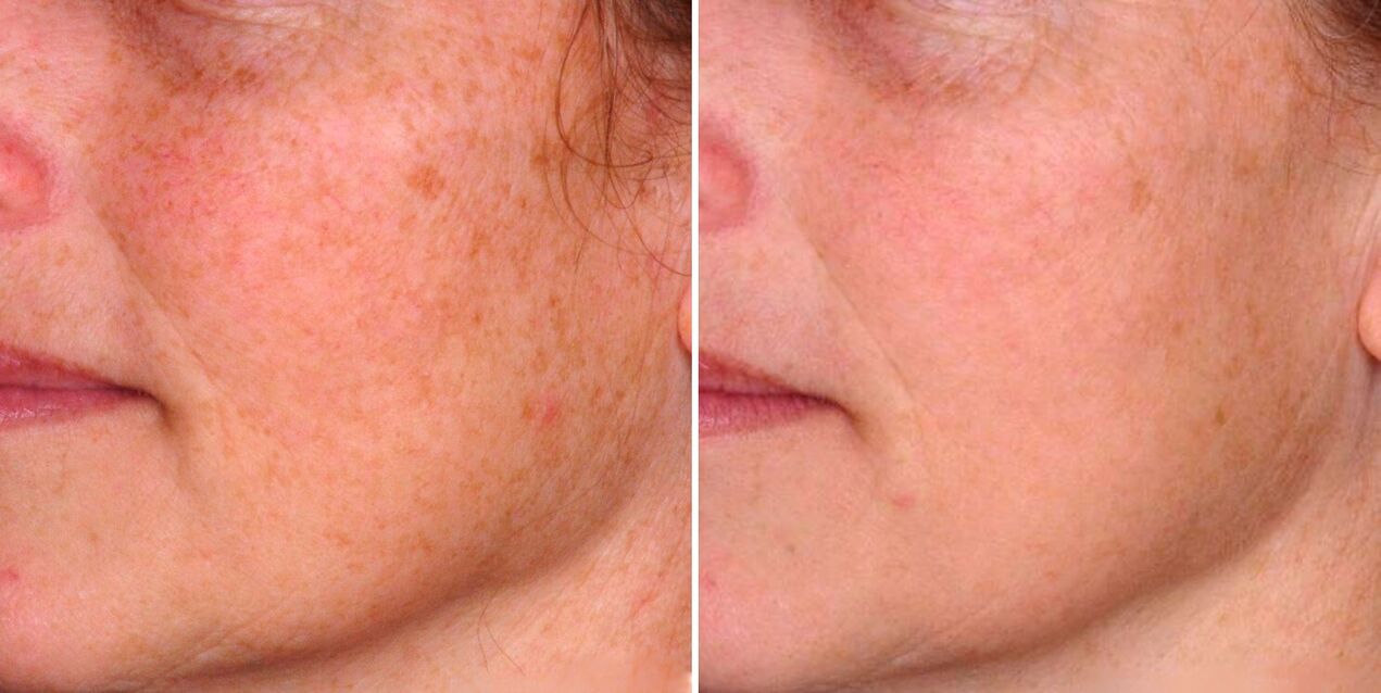 Het resultaat van fractionele fotothermolyse is de vermindering van ouderdomsvlekken op de huid van het gezicht. 