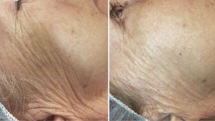 voor en na laser huidverjonging
